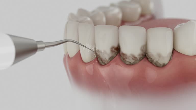 Trusted Wisdom Tooth Removal service in Burlington, ND - Dentist Open Now
